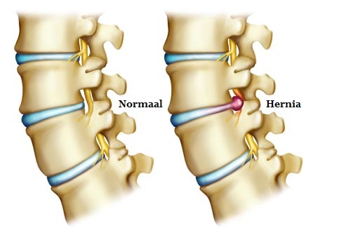 Rugbrace Hernia